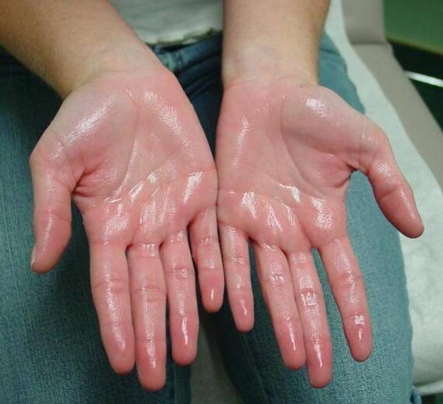 gipergidroz